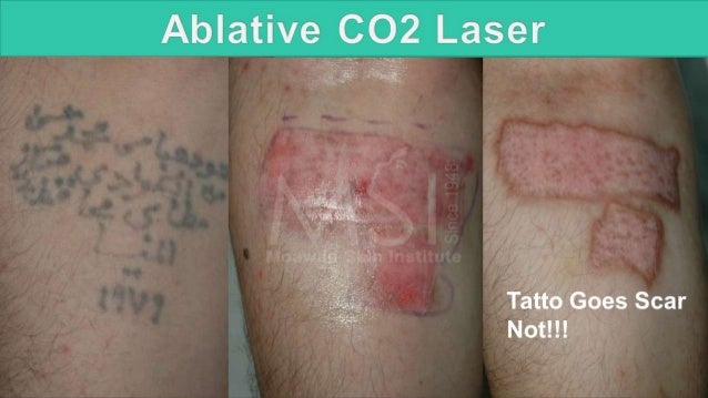 LASER TATTOO REMOVAL. THE SAVIOR